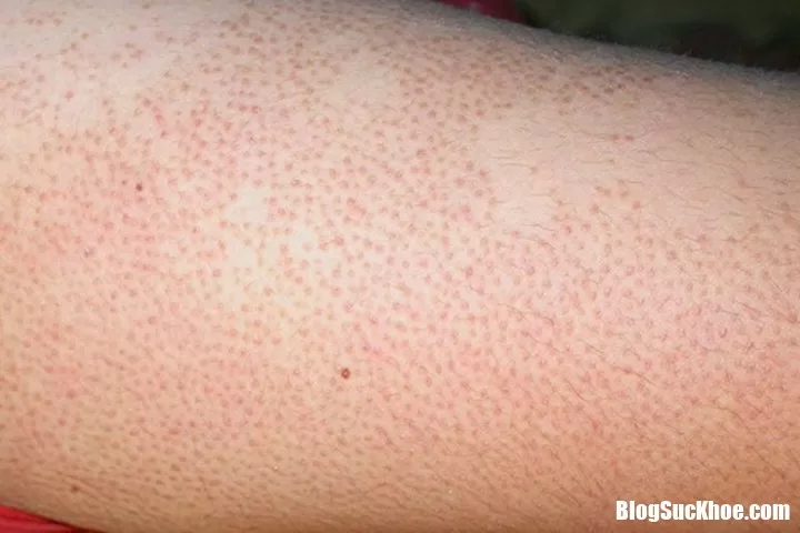 3 Mẹo trị dứt điểm viêm lỗ chân lông an toàn, hiệu quả