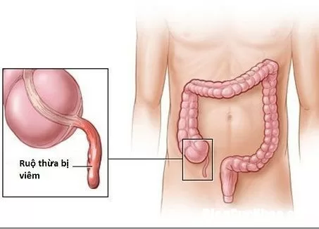 Dấu hiệu nhận biết đau ruột thừa dễ nhầm lẫn với đau bụng thông thường