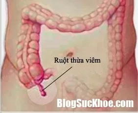 Nhận biết bệnh viêm ruột thừa