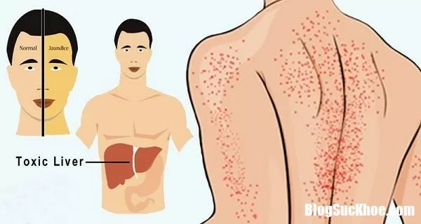 Những biểu hiện đáng lo nên đi khám gan ngay
