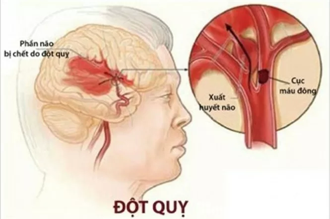 Cách xử trí khi nghi ngờ đột quỵ
