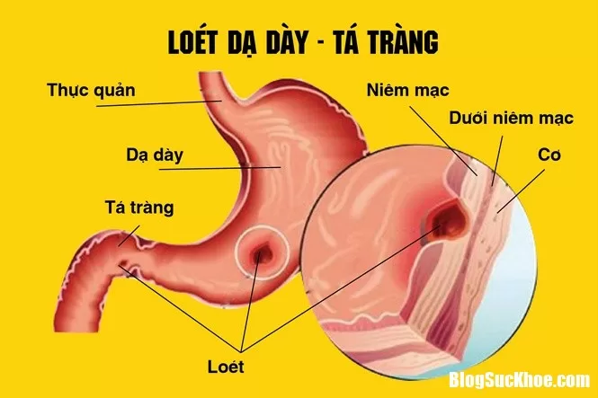Dấu hiệu cho biết chắc chắn là bạn đã bị viêm dạ dày - tá tràng