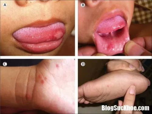 Chăm sóc bệnh tay chân miệng sai cách dễ gây biến chứng
