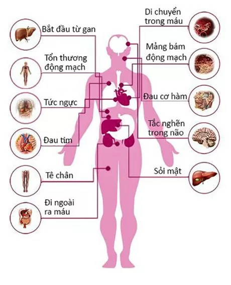 Cholesterol cao nguy hiểm như thế nào?