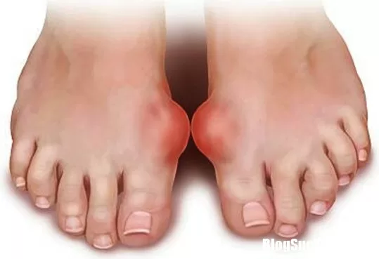 Những bài thuốc đơn giản chữa bệnh gout hiệu quả