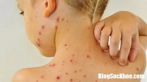 Tìm hiểu về bệnh thủy đậu