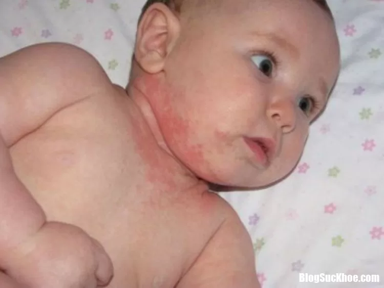 Chớ dại mà bôi thuốc viêm da chứa corticoid cho con nữa, đang hại con mà không hay đó