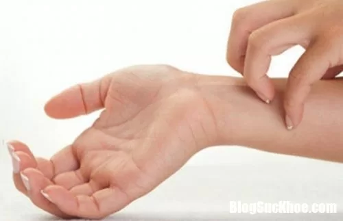Chế độ ăn uống cho người bị viêm da cơ địa