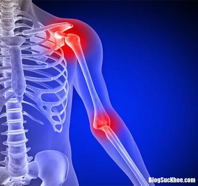 Đau nhức xương khớp là dấu hiệu của bệnh gì ?