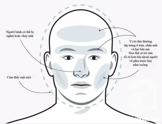 Phân biệt các nguyên nhân gây đau đầu để biết cách điều trị cho đúng
