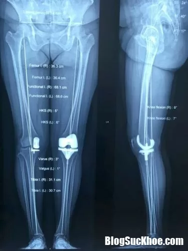 Thoái hóa khớp ngày càng trẻ hóa, nguyên nhân do đâu ?