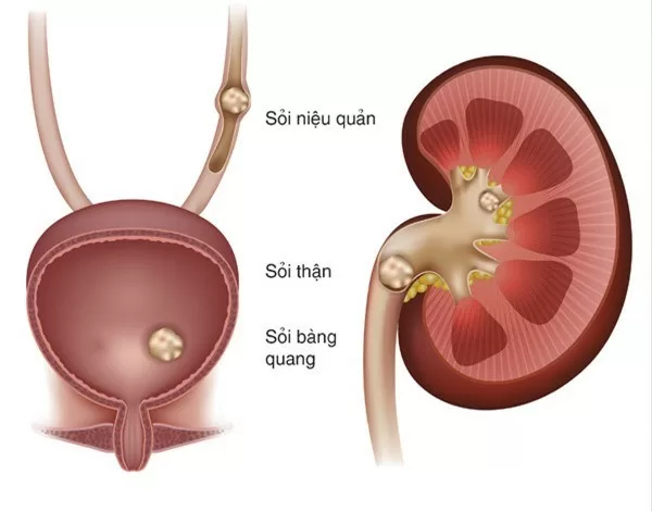 Sỏi thận và những biến chứng nguy hiểm không ngờ
