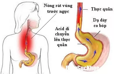 Ăn chay tốt cho người bị trào ngược dạ dày thực quản