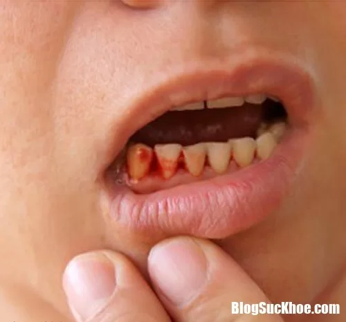 Chảy máu chân răng nguy hiểm hơn bạn nghĩ nhiều, hãy đến bệnh viện ngay