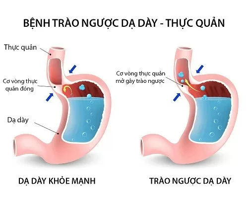 Chế độ ăn uống cho bệnh trào ngược dạ dày