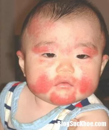 Cách xử trí khi trẻ bị dị ứng thức ăn