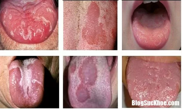 Vì sao lưỡi lại xuất hiện màu trắng?