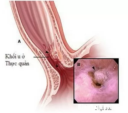 Triệu chứng của ung thư thực quản