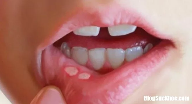 Hết nhiệt miệng với bài thuốc cực đơn giản từ dân gian