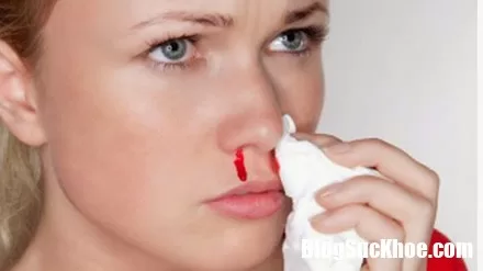 Chảy máu cam có thể là dấu hiệu của những căn bệnh nguy hiểm đang tiềm ẩn