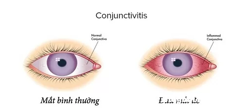 Cảnh báo dịch đau mắt đỏ chuẩn bị vào mùa