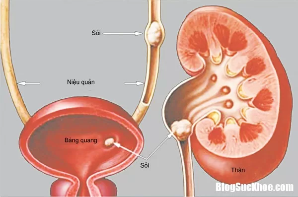 Nguyên nhân và cách phòng bệnh sỏi tiết niệu