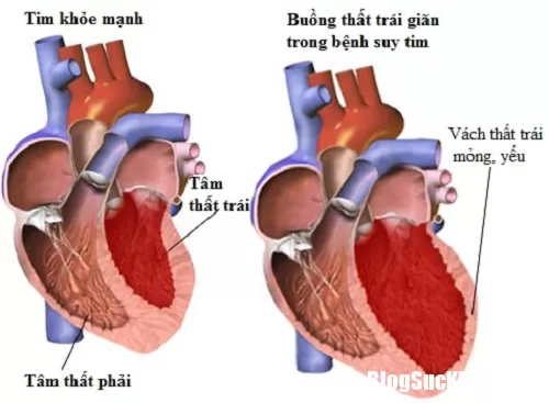 Tìm hiểu về bệnh suy tim