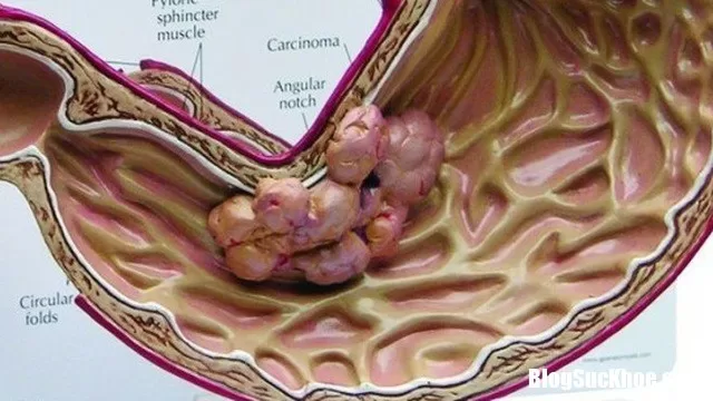 Những thực phẩm quen thuộc hằng ngày không ngờ lại là nguyên nhân gây ung thư dạ dày