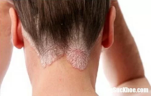 Bài thuốc cổ truyền trị bệnh vảy nến