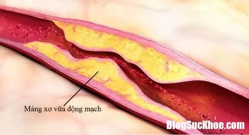 Xơ vữa động mạch nguy hiểm đến mức nào ?