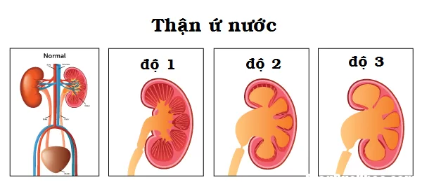 Cách nhận biết bệnh thận ứ nước