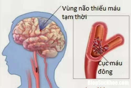 Cách để nhận biết bệnh tai biến mạch máu não