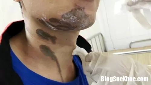 Nước tẩy rửa nhà vệ sinh có thể gây bỏng nặng