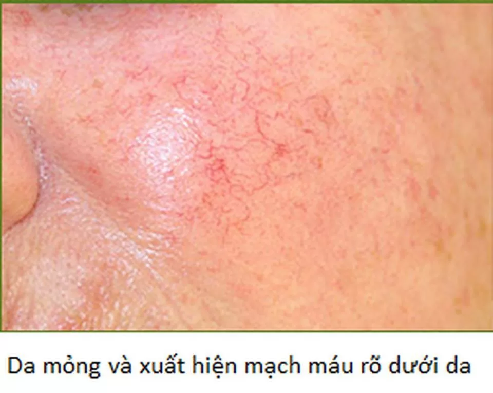 Hậu quả khó lường của việc lạm dụng thuốc chứa corticoid