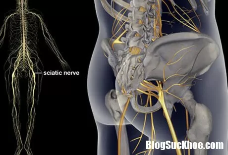 Đau thần kinh toạ - Nguyên nhân do đâu ?