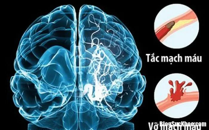 Những dấu hiệu thoáng qua cảnh báo bệnh đột quỵ cực nguy hiểm mà ít ai để ý