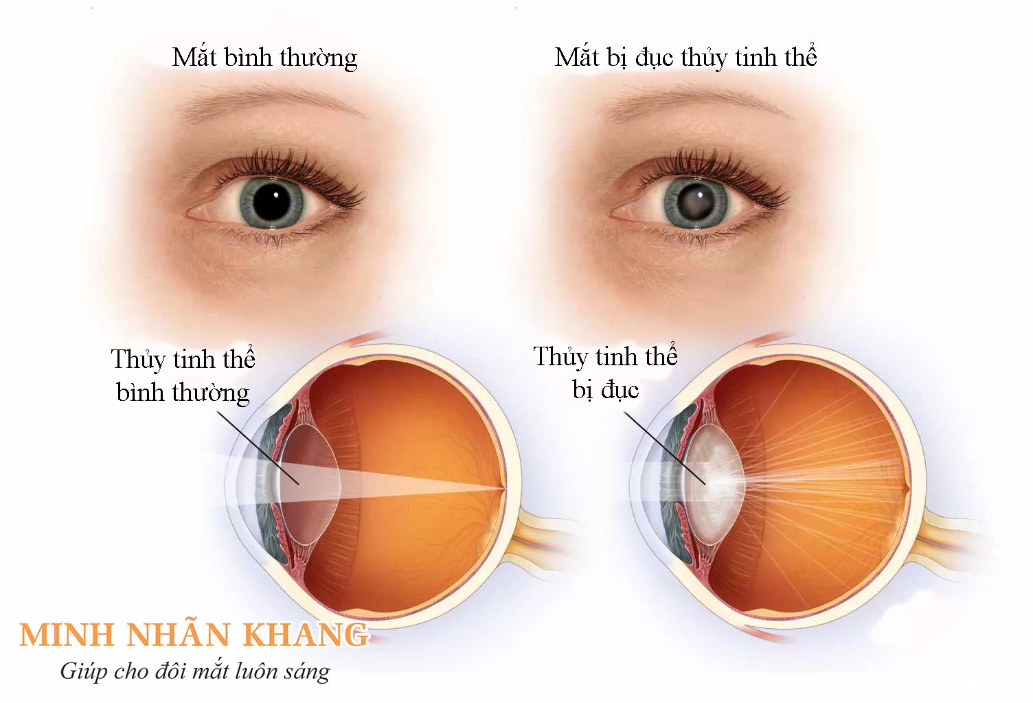 Nhận biết bệnh đục thủy tinh qua những dấu hiệu thầm lặng