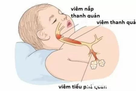 Đề phòng bệnh viêm tiểu phế quản ở trẻ khi trời trở lạnh