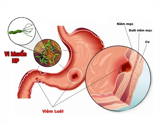 Những món ăn nên tuyệt đối tránh xa nếu đanh bị đau dạ dày