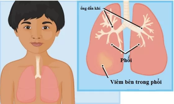 Dinh dưỡng cần thiết cho trẻ viêm phổi