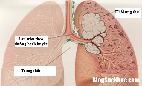 Cách chăm sóc bệnh nhân ung thư phổi