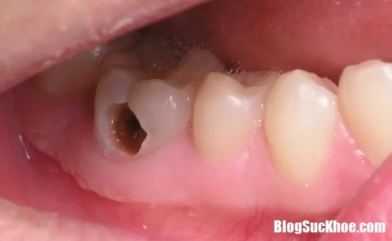 Những cách đơn giản trị sâu răng bằng thiên nhiên