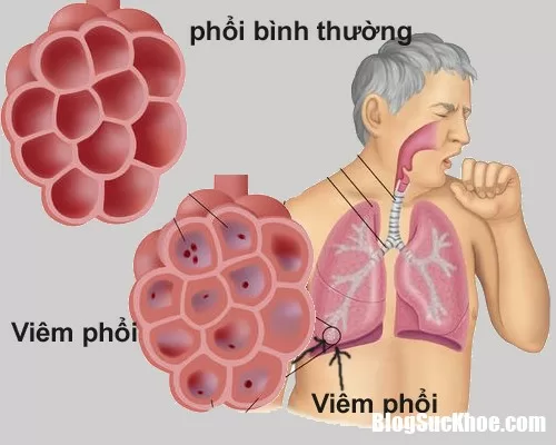 Những thực phẩm tốt cho người bị bệnh viêm phổi