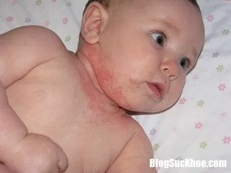 Bé bị viêm da kích ứng do sự chủ quan thiếu hiểu biết của cha mẹ khi tắm cho con