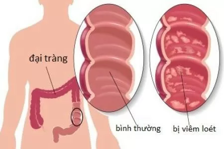 Chữa viêm đại tràng do virut gây ra bằng thực phẩm