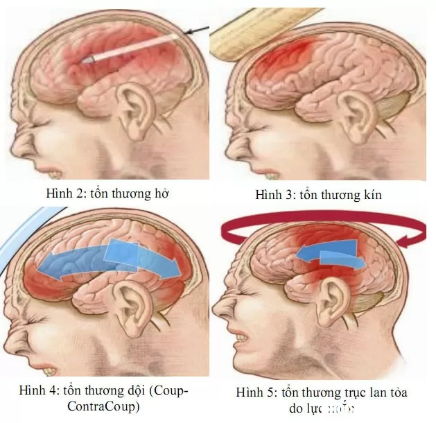 Cách nhận biết chấn thương sọ não