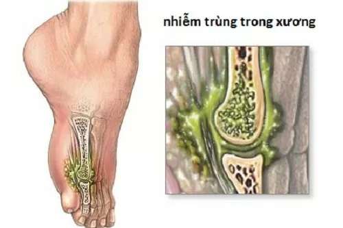 Những triệu chứng của bệnh viêm tủy xương