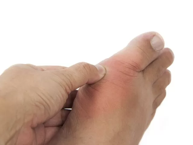Cách chăm sóc phòng tránh viêm khớp tái phát do bệnh gút