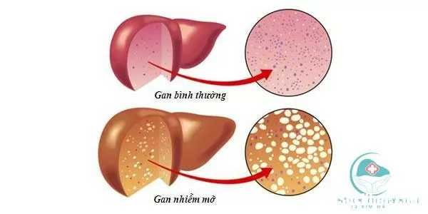 Những biến chứng nguy hiểm của gan nhiễm mỡ ít người biết