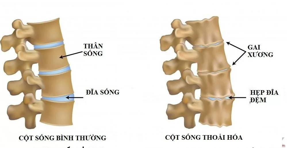 Gai cột sống - Kẻ sát thủ âm thầm giấu mặt